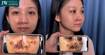 Bác sĩ Tú Dung chuyển vạt ghép da cứu nữ sinh tai nạn giao thông