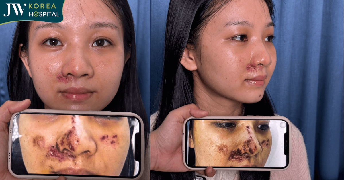 Bác sĩ Tú Dung chuyển vạt ghép da cứu nữ sinh tai nạn giao thông