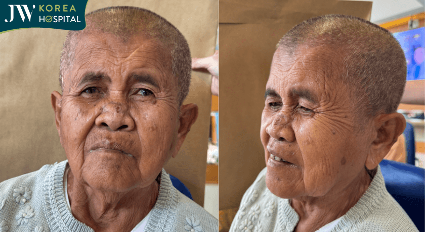 Bác sĩ Tú Dung cắt U hắc tố cho sư bà Khơ me