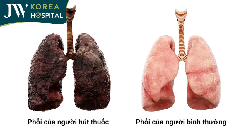 tác hại ung thư phổi của người hút thuốc lá truyền thống hay thuốc lá điện tử vape