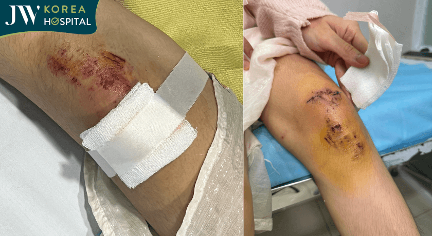 vết thương chân