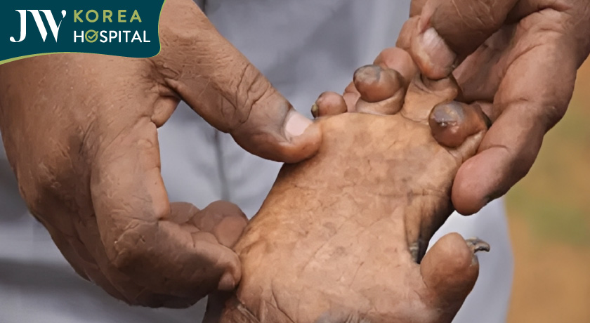 Người mắc bệnh phong có thể bị teo cơ, cơ thể bị biến dạng