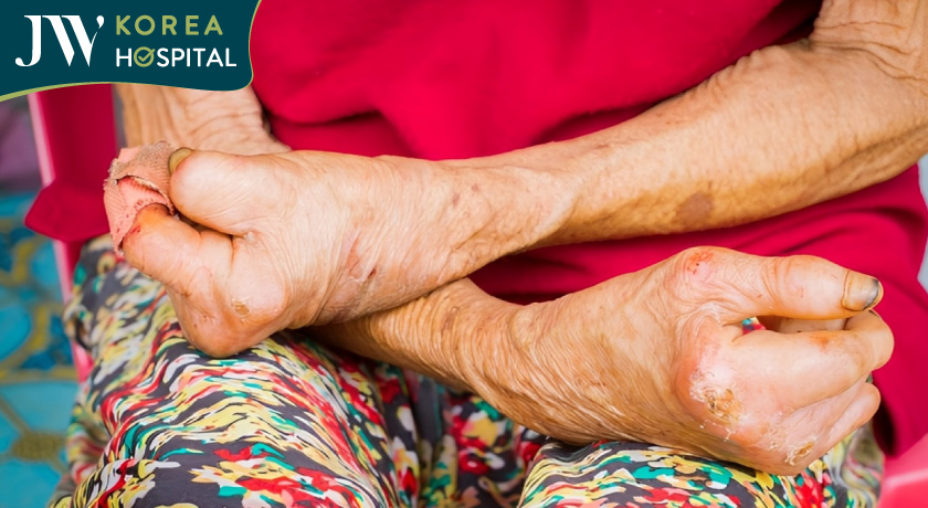 Bệnh phong gây nên yếu cơ, biến dạng cơ thể