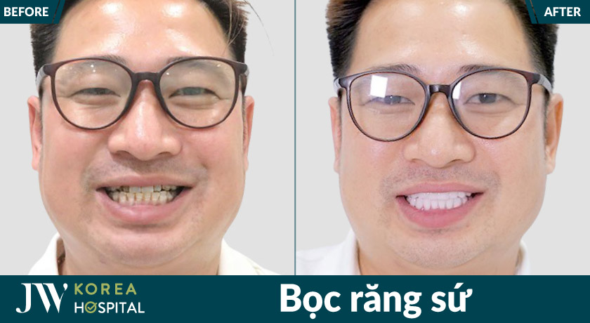 Bọc răng sứ tại JW giúp sở hữu răng trắng sáng, nụ cười đẹp tinh tế chỉ sau 1 quá trình thực hiện