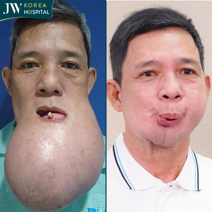 Chú Khanh bệnh nhân U nguyên bào men được bác sĩ Tú Dung và bệnh viện JW điều trị thành công