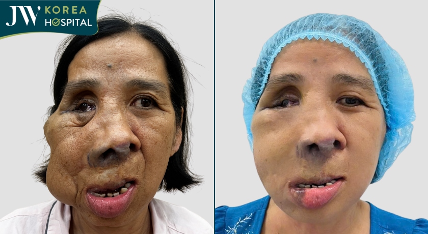 Cô Lê Thị Màng mắc khối u mạch máu được điều trị thành công tại Bệnh viện JW