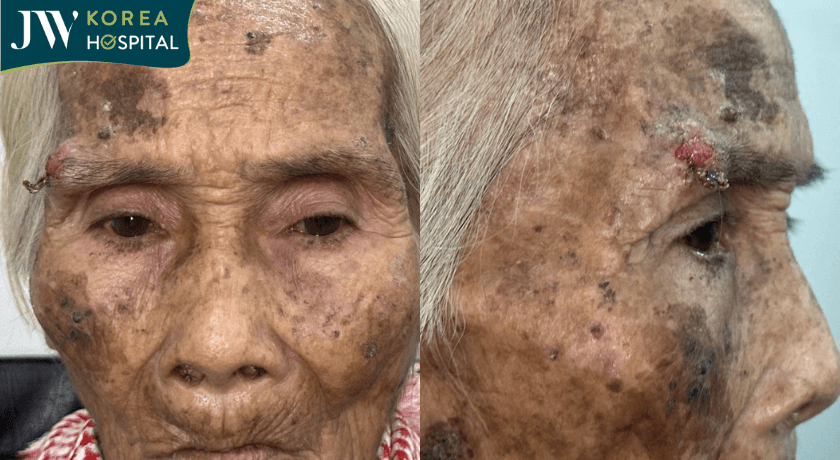 cụ bà mắc khối U vùng chân mày bị rỉ máu suốt 2 năm
