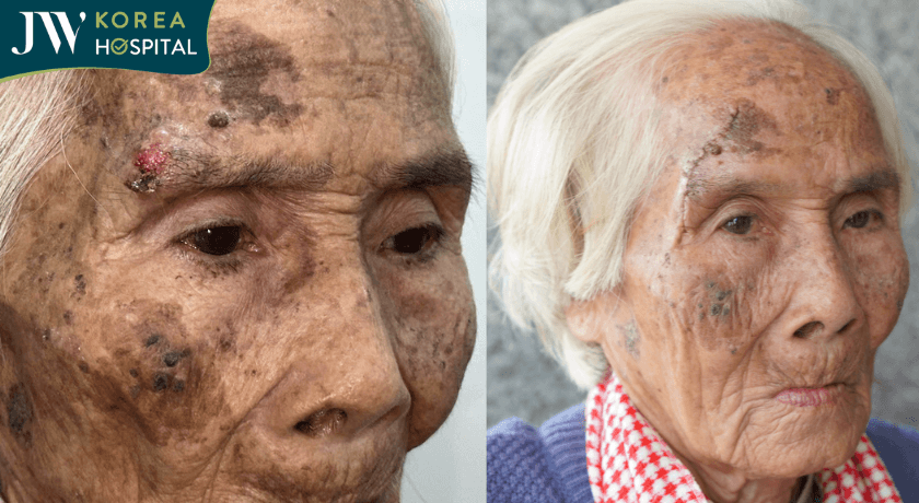 cụ bà trước và sau phẫu thuật cắt khối U