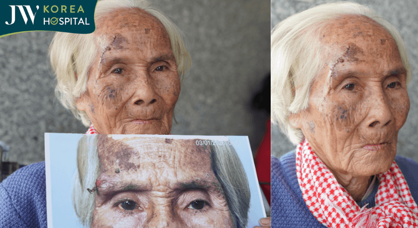 cụ bà tưới tắn sau khi cắt khối U vùng chân mày