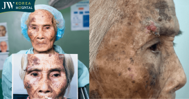 cụ INH khối u lở loét tìm đến bệnh viện jw cầu cứu bác sĩ tú dung