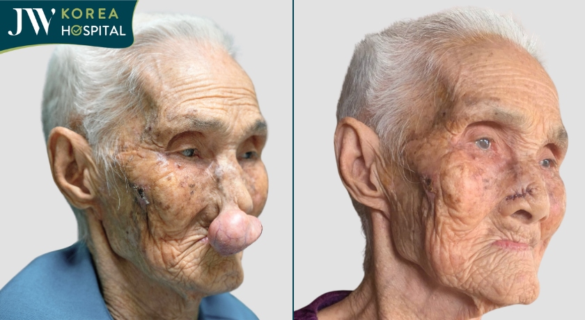 Cụ Lê Thị Khoan 100 tuổi mắc khối u mạch máu chèn ép đường thở suốt 30 năm được điều trị thành công tại Bệnh viện JW