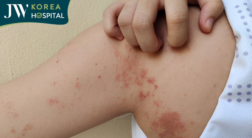 cơ thể xuất hiện những vết đỏ loang lổ là dấu hiệu ban đầu của bệnh phong