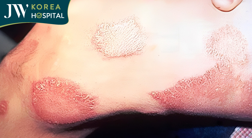 người mắc bệnh phong trên cơ thể xuất hiện nhiều vết đỏ loang lổ