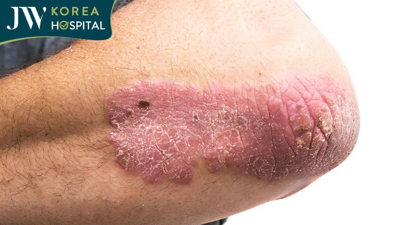 dấu hiệu nhận biết bệnh phong là cơ thể xuất hiện những vết đỏ sần sùi không đều nhau trên da