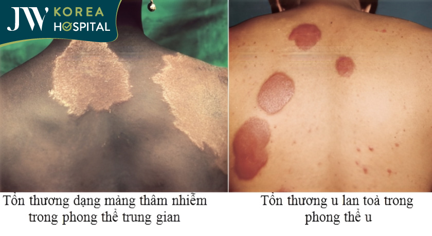 Những dấu hiệu phổ biến nhận biết bệnh phong là cơ thể xuất hiện những vết màu đỏ trên da