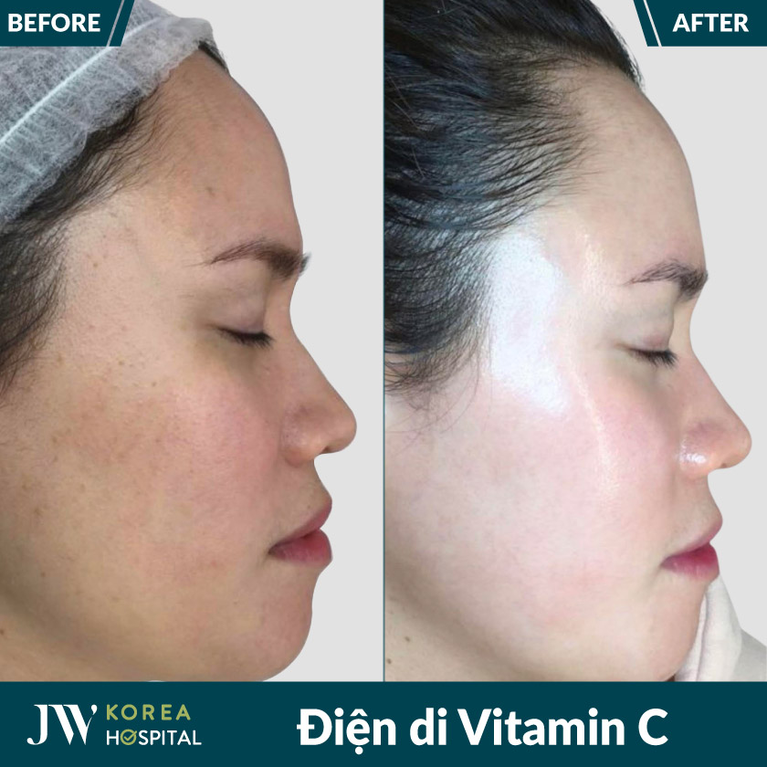 Điện di Vitamin C tại Bệnh viện JW giúp làn da sáng mịn, căng bóng, rạng rỡ