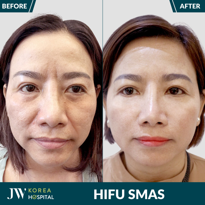 HIFU SMAS tại Bệnh viện JW giúp trẻ hóa, nâng cơ không cần phẫu thuật