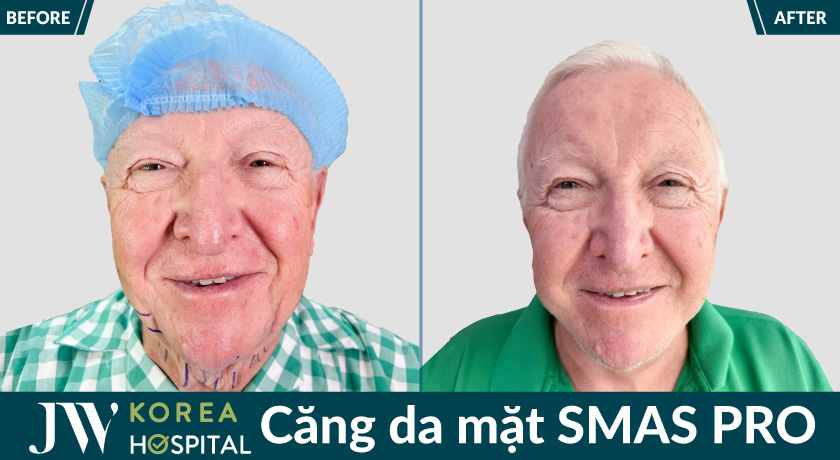 kết quả căng da mặt smaspro tại Bệnh viện JW