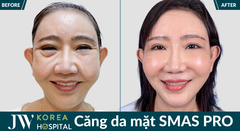 Kết quả căng da mặt smaspro tại bệnh viện JW