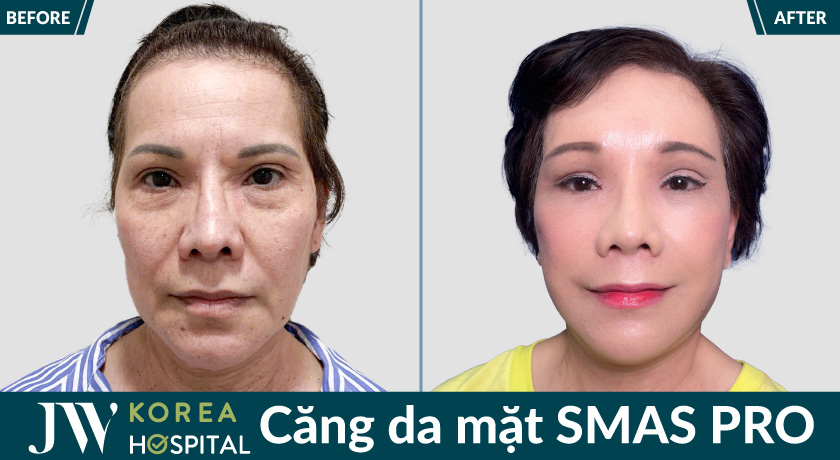 Kết quả căng da mặt smaspro tại Bệnh viện JW