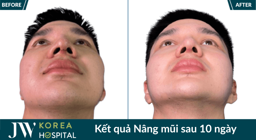 kết quả nâng mũi sau 10 ngày