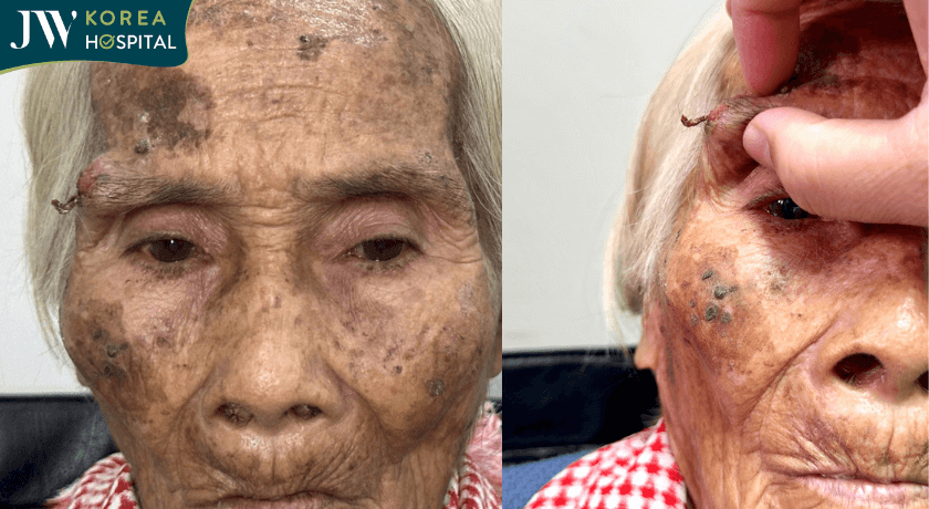 Khối U cụ bà 90 tuổi