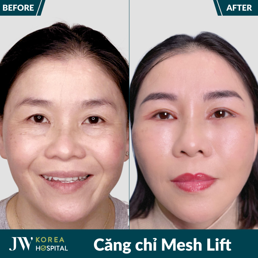 Căng chỉ Mesh Lift tại Bệnh viện JW giúp hỗ trợ nâng mô, cải thiện đường nét gương mặt không cần phẫu thuật.
