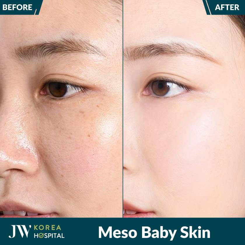 Meso Baby Skin giúp sở hữu làn da căng bóng, mịn màng như em bé chỉ sau 1 liệu trình