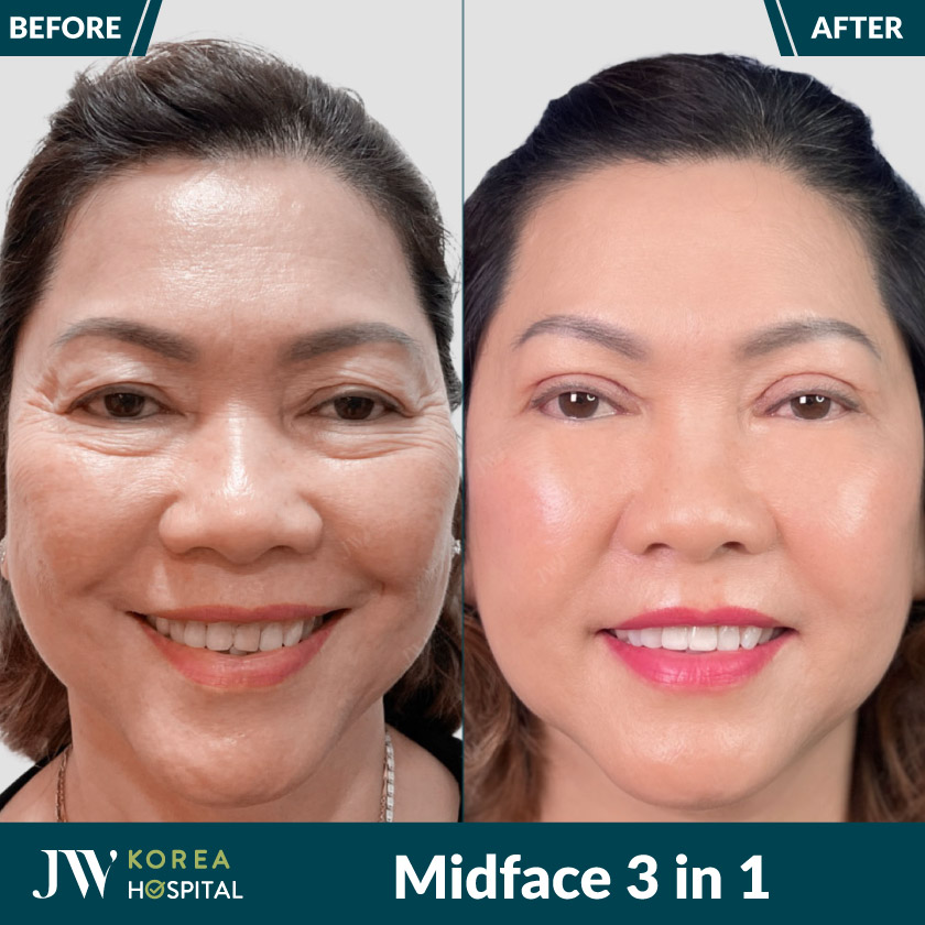 midface 3 in 1 tai benh vien jw giup xoa bong mat tre 10 tuoi 251x251