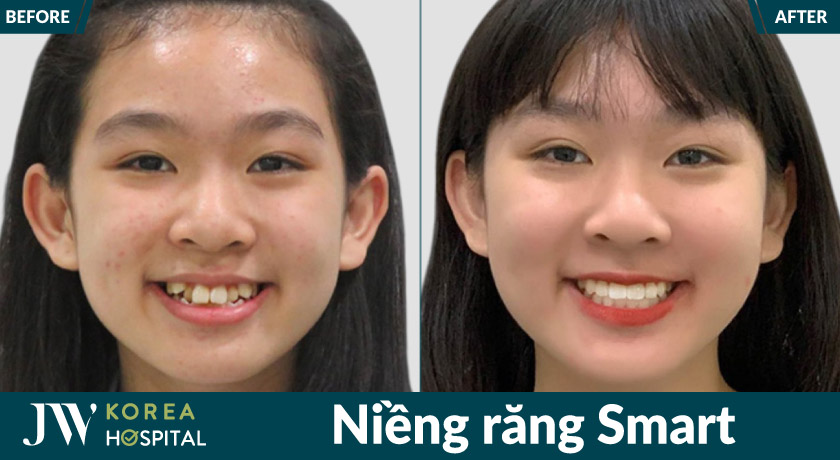 Niềng răng Smart tại Bệnh viện JW giúp cải thiện khớp cắn chuẩn, sở hữu nụ cười đẹp chuẩn Hàn