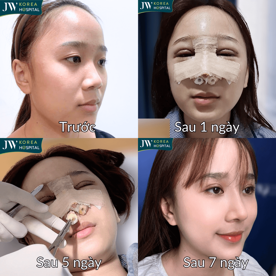 qua trình hồi phục sau nâng mũi