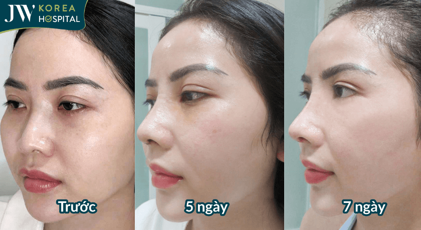 quá trình hồi phục sau nâng mũi