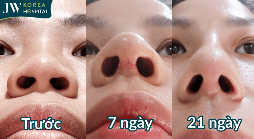 quá trình hồi phục sau 21 ngày Nâng mũi