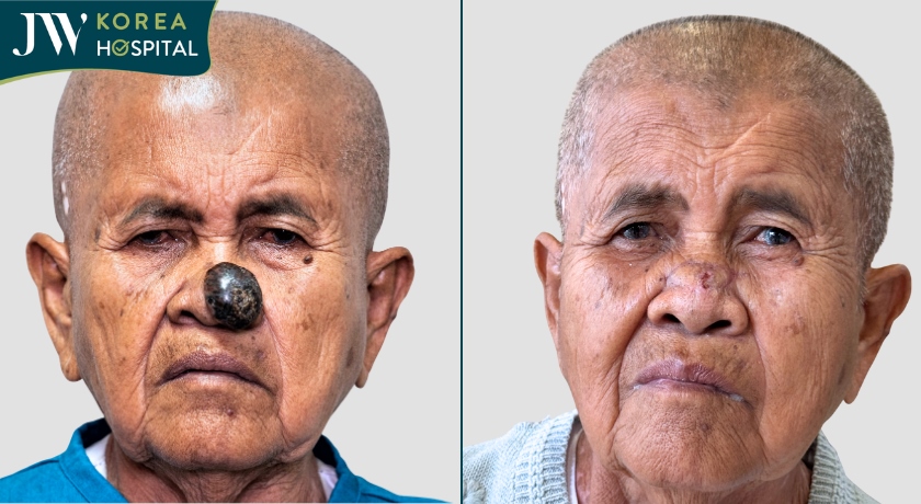 Sư bà Khơ-me mắc khối u ác tính được bệnh viện JW cắt bỏ u thành công