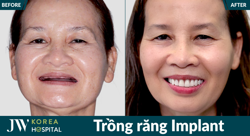 U50 - U80 mất răng lâu năm cải thiện chức năng ăn nhai, cười tự tin với Trồng răng Implnat tại Bệnh viện JW