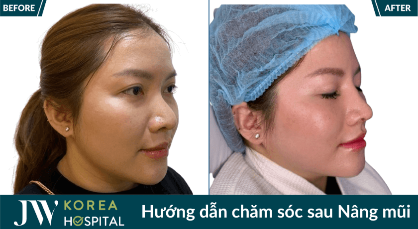 trước và sau khi hàng quay lại tái khám sau nâng mũi