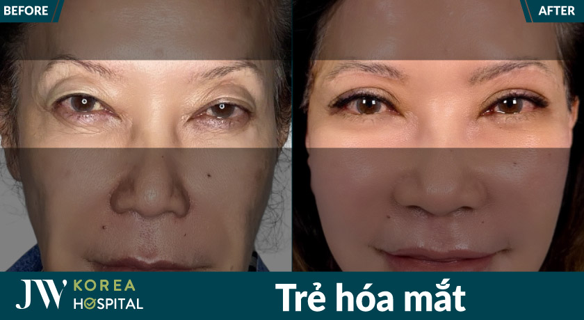 U40 - U80 xóa mí sụp, trẻ lùi 10 tuổi sau thực hiện dịch vụ trẻ hóa mắt tại Bệnh viện JW