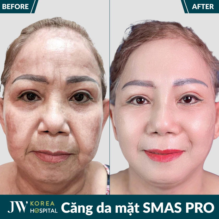 Căng da mặt SMAS PRO tại Bệnh viện JW – nâng cơ, trẻ hóa da chảy xệ an toàn theo chuẩn y khoa