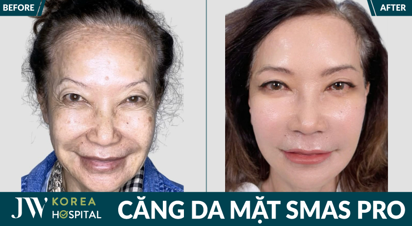căng da, xóa nhăn, trẻ lùi 20 tuổi với Căng da mặt SMAS PRO tại bệnh viện JW