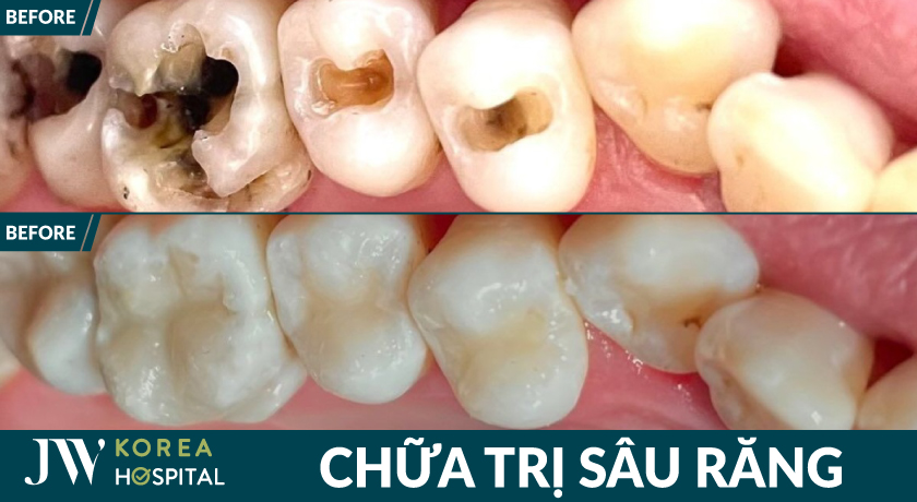 Chữa dứt điểm tình trạng sâu răng chỉ sau 1 quá trình thực hiện tại bệnh viện JW 