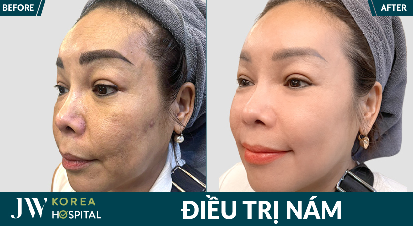 cải thiện 98% nám lâu năm, tàn nhang, đồi mồi sau 1 liệu trình điều trị nám chuẩn y khoa tại bệnh viện JW