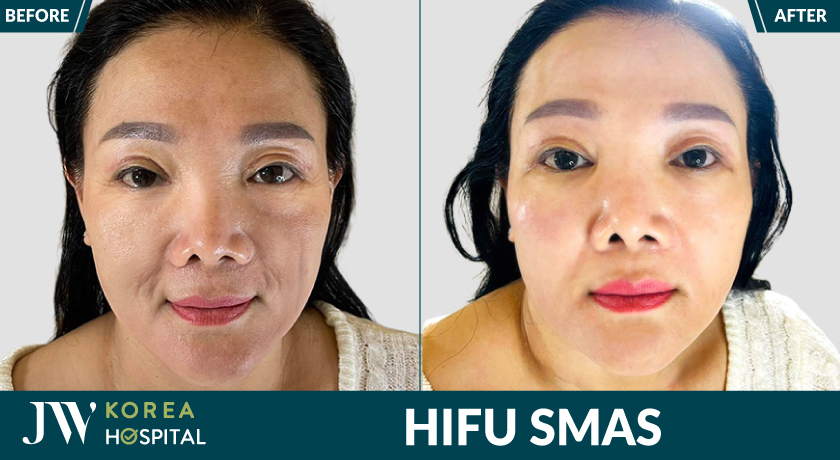Da căng, xóa nếp nhăn, rãnh cười sâu với HIFU SMAS tại Bệnh viện JW