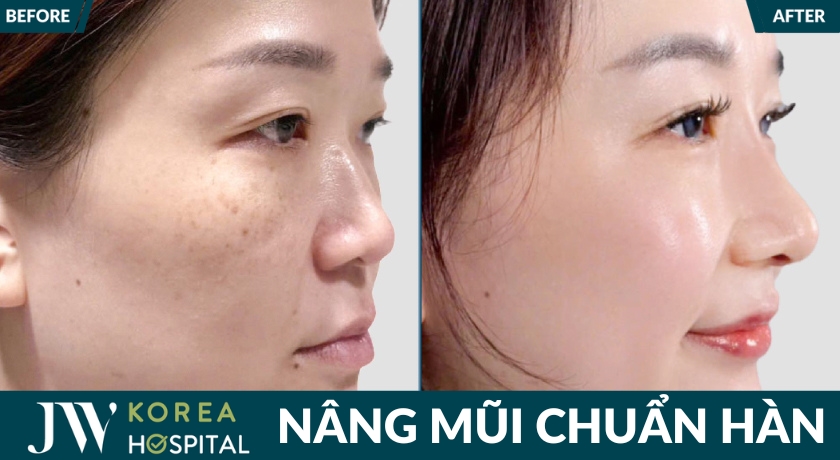 Nâng mũi chuẩn Hàn tại Bệnh viện JW giúp sở hữu dáng mũi cao tự nhiên, đầy cuốn hút