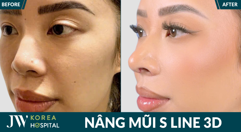 Mũi cao sang, cuốn hút chuẩn thần thái với nâng mũi S Line 3D tại bệnh viện JW