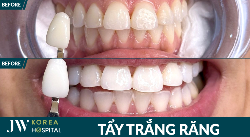 Khắc phục răng ố vàng, xỉn màu với 1 quá trình tẩy trắng răng tại JW