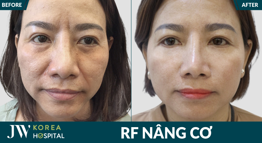 Xóa nhăn hiệu quả với công nghệ RF nâng cơ chuẩn Hàn tại bệnh viện JW 
