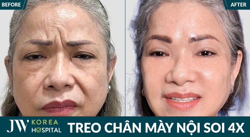 Xóa rãnh cau mày, mí sụp với Treo chân mày nội soi 4X tại Bệnh viện JW