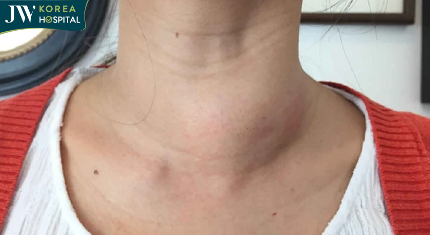 Bệnh bướu cổ khiến cổ sưng to bất ngờ 