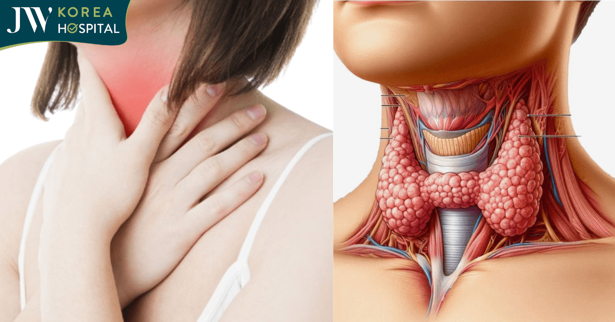 Bướu cổ: Nguyên nhân, dấu hiệu và cách điều trị chuẩn Y khoa tại JW