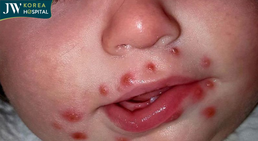 Mun nhỏ nổi quanh miệng khi trẻ mắc bệnh tay chân miệng